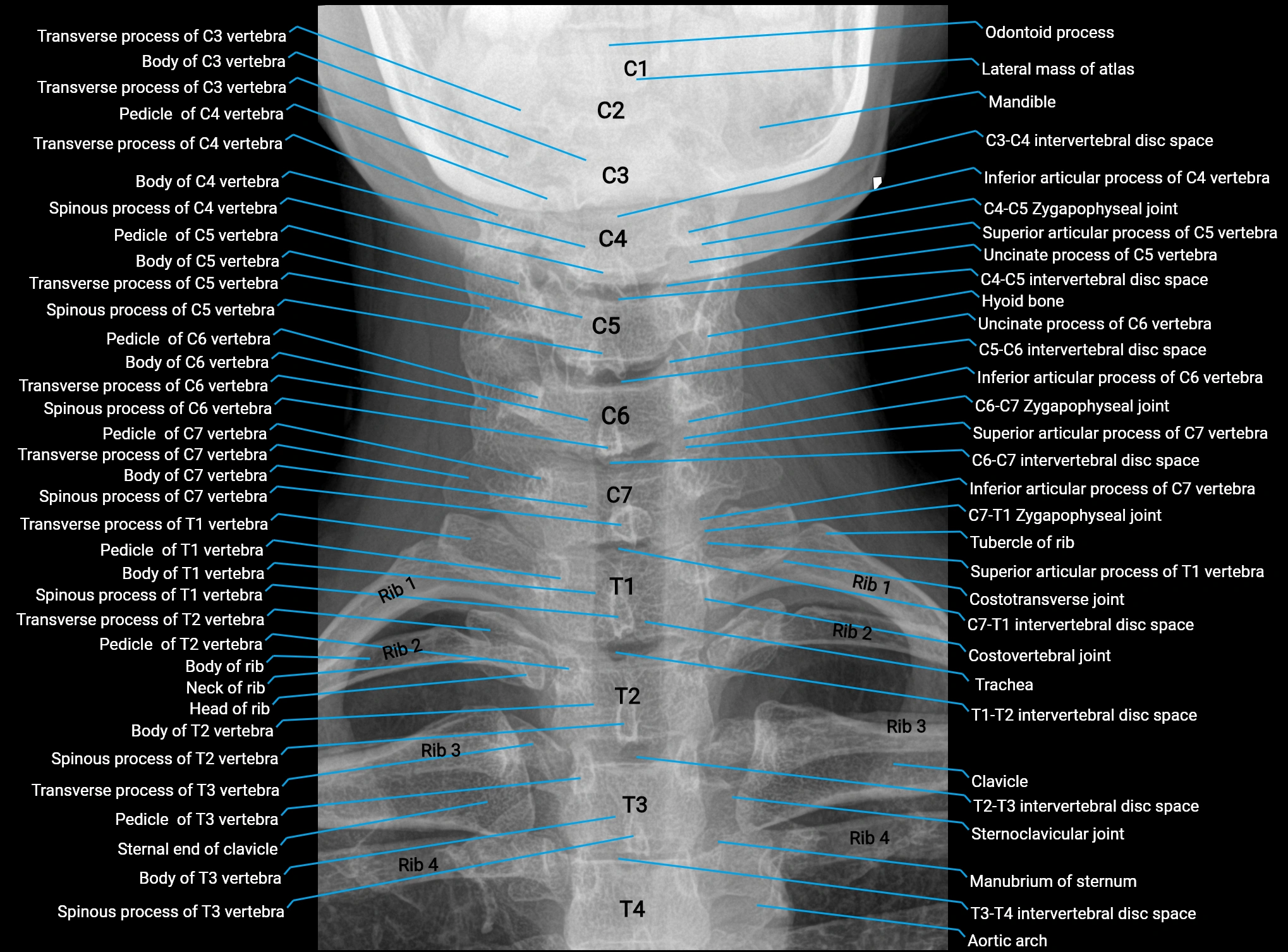 X Ray cervical spine AP anatomy labelled.webp